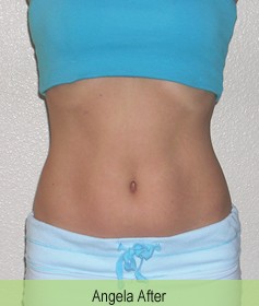 Angela After Mesotherapy