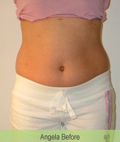Angela Before Mesotherapy