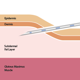 Testosterone Pellet Therapy Diagram