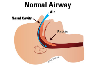In a healthy individual, air travels freely through the airway into the lungs.