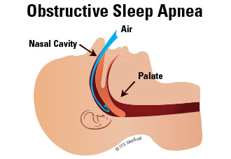 In the case of obstructive sleep apnea, enlarged tissue blocks the air passageway, disrupting breathing patterns.