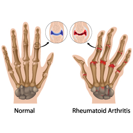 Understanding Arthritis