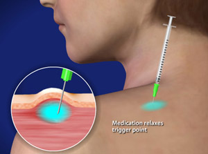 Trapezius muscle pain & trigger points