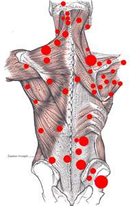 Trigger Point Spots