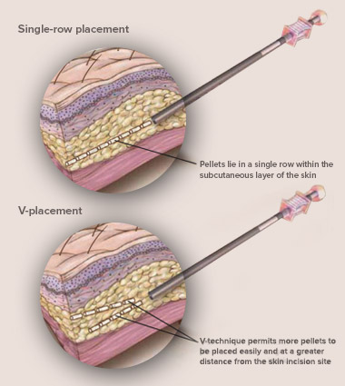 Pellet Insertion