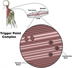 Trigger point complex