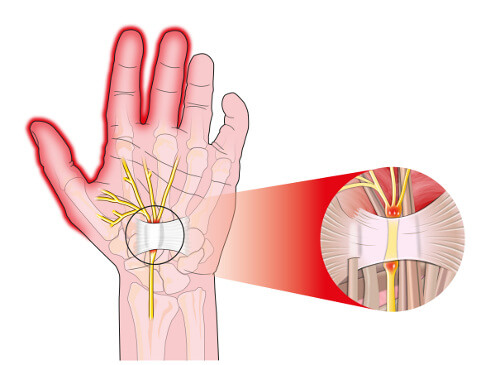 Carpal tunnel