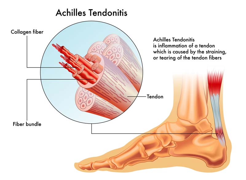 Achilles Tendonitis Treatment