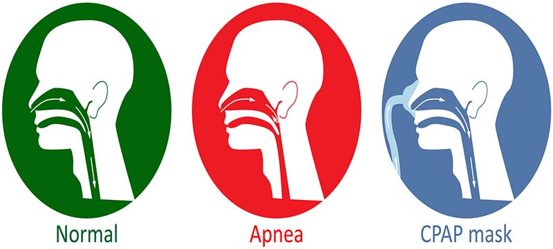 Pros And Cons Of Cpap Masks