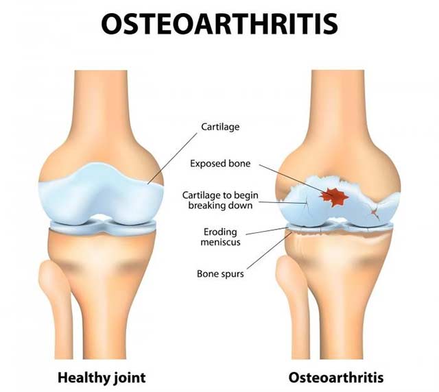 Healthy Joint Versus Osteoarthritis
