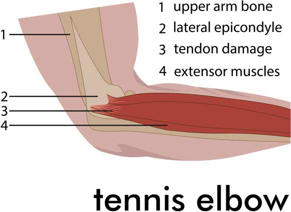 Tennis Elbow