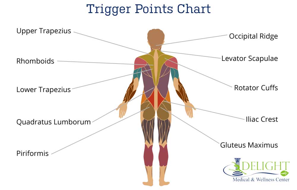 Trigger Points Chart