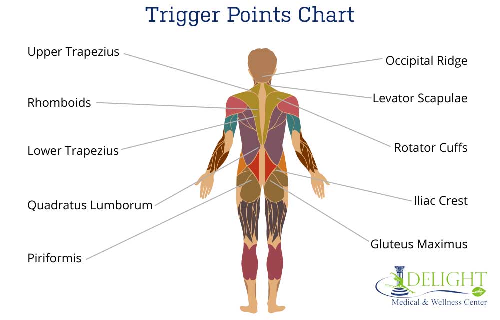 Trigger Point Referred Chart