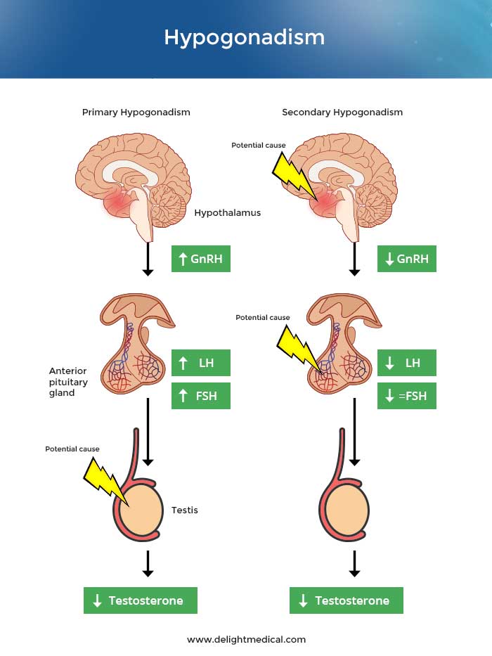 Hypogonadism Delight Medical And Wellness Center